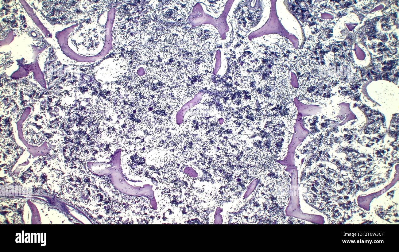Menschliches rotes Knochenmark, hämatopoetische Presse. Die großen Tsit-Beetveen-Erythrozyten sind Megakaryozyten. Hämatoxylin- und Eosin-Färbung. Stockfoto