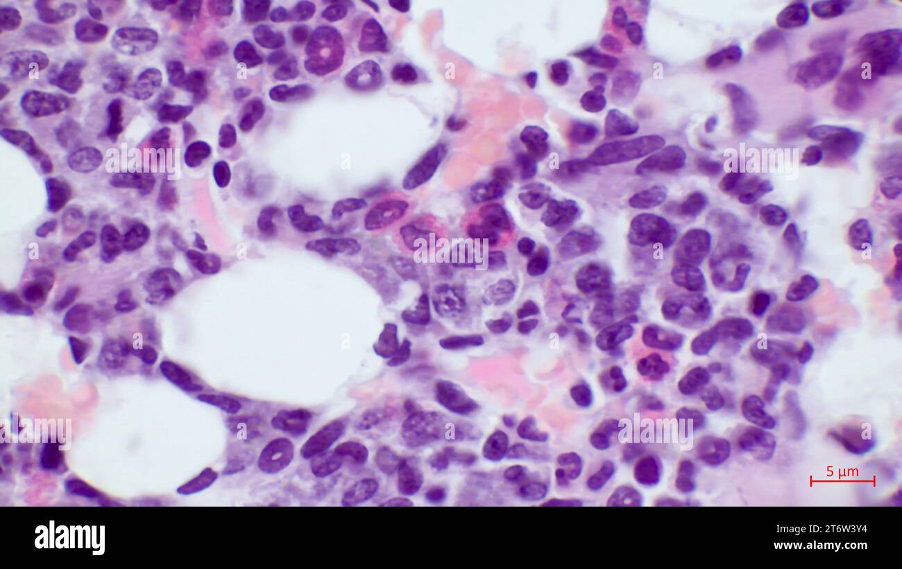 Histologischer Schnitt des roten Knochenmarks mit hämatopoetischen Inseln. Lichtmikroskopische Darstellung der Blutzellbildung im menschlichen Knochenmarkgewebe. Stockfoto