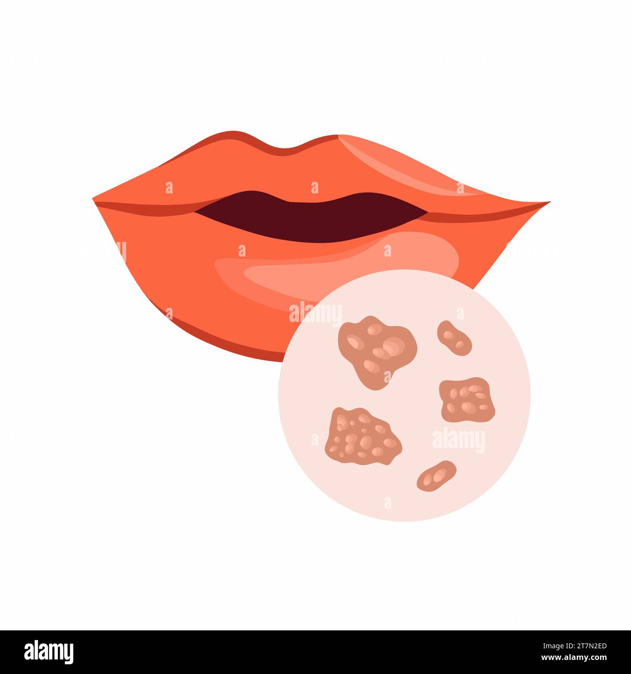 Vektorisolierte Darstellung von Herpes an den Lippen. Infektion mit dem Herpesvirus. Verminderte Immunität. Stock Vektor