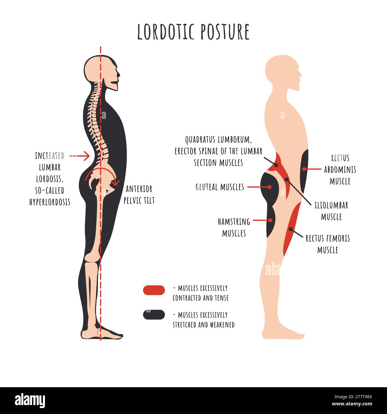 Haltungsstörungen Infografiken. Lordotische Haltung. Die Seitenansicht zeigt Hyperlordoseverformung, Wirbelsäulenkrümmung, Beckenrotation, gedehnte und geschwächte Muskeln, verkürzte Muskeln und Spannmuskeln. Vektorabbildung. Stock Vektor