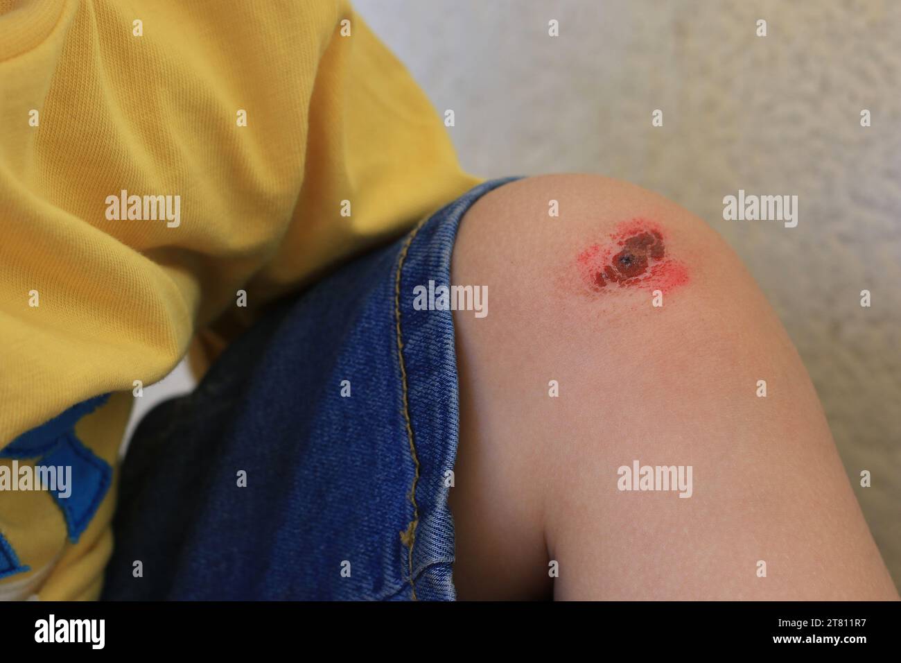 Ein Wundschorf auf den Knien des Kindes als Folge eines Sturzes. Stockfoto