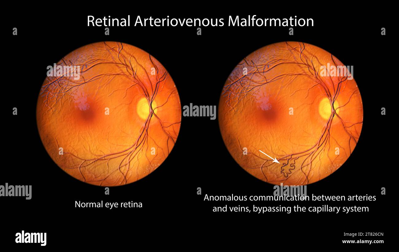 Retinale arteriovenöse Malformation, Illustration Stockfoto