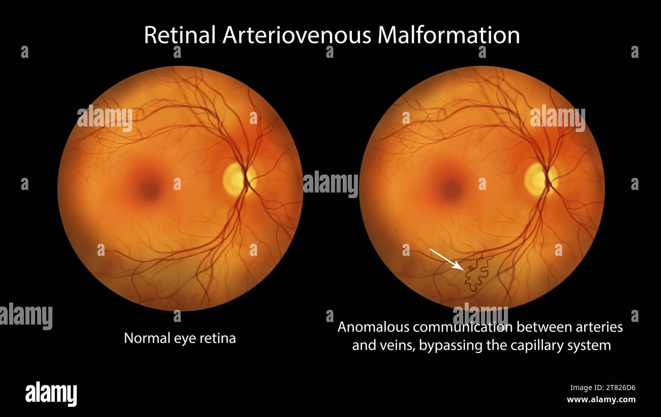 Retinale arteriovenöse Malformation, Illustration Stockfoto