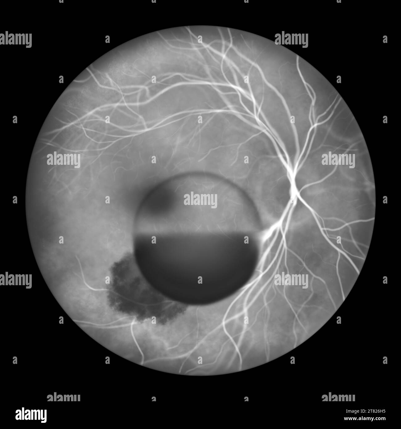 Intraokulare Blutung bei Terson-Syndrom, Illustration Stockfoto