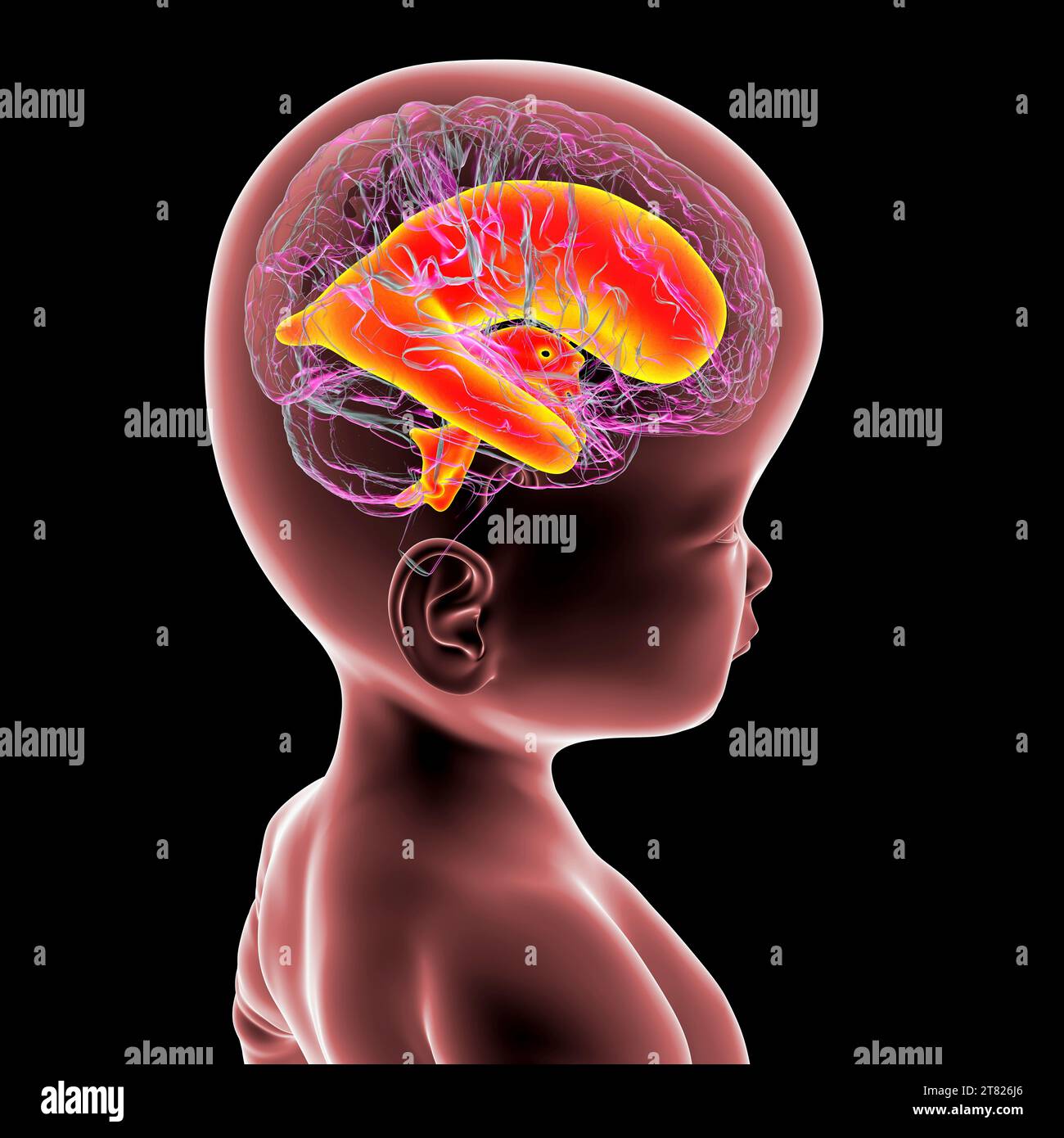 Baby mit vergrößerten Hirnventrikeln, Illustration Stockfoto