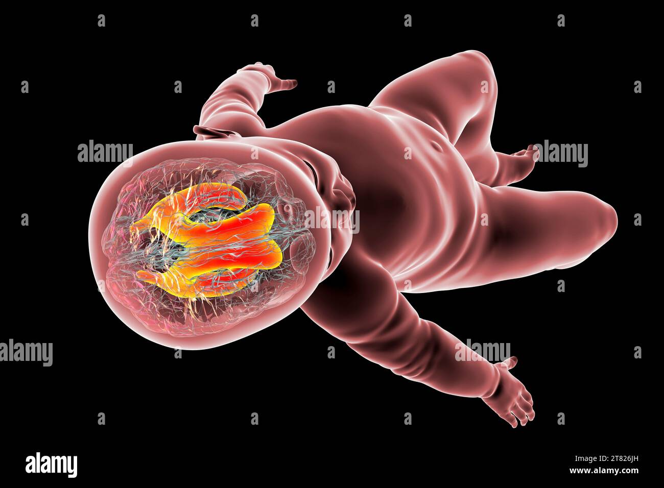 Baby mit vergrösserten lateralen Ventrikeln, Illustration Stockfoto