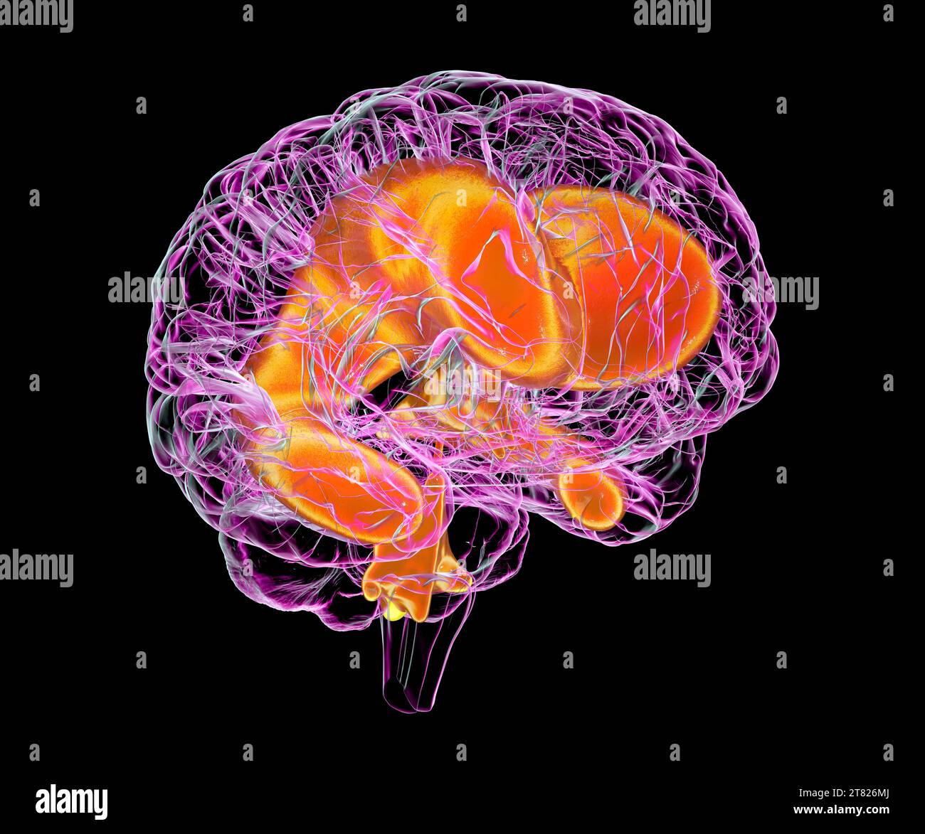Vergrößerte Ventrikel des kindlichen Gehirns, Illustration Stockfoto
