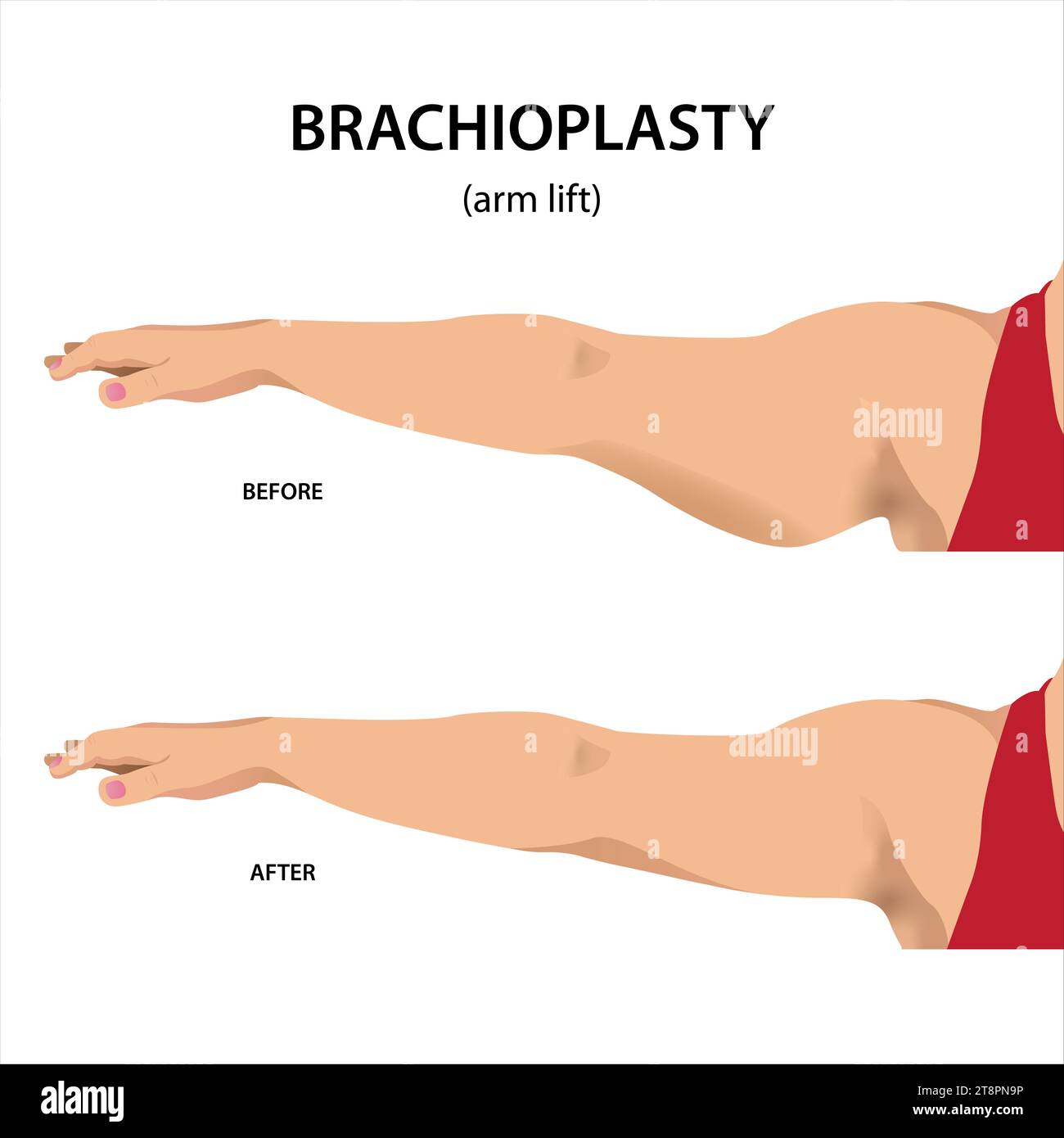 Abbildung der Brachioplastik (Armheben) vor und nach der Behandlung Stockfoto