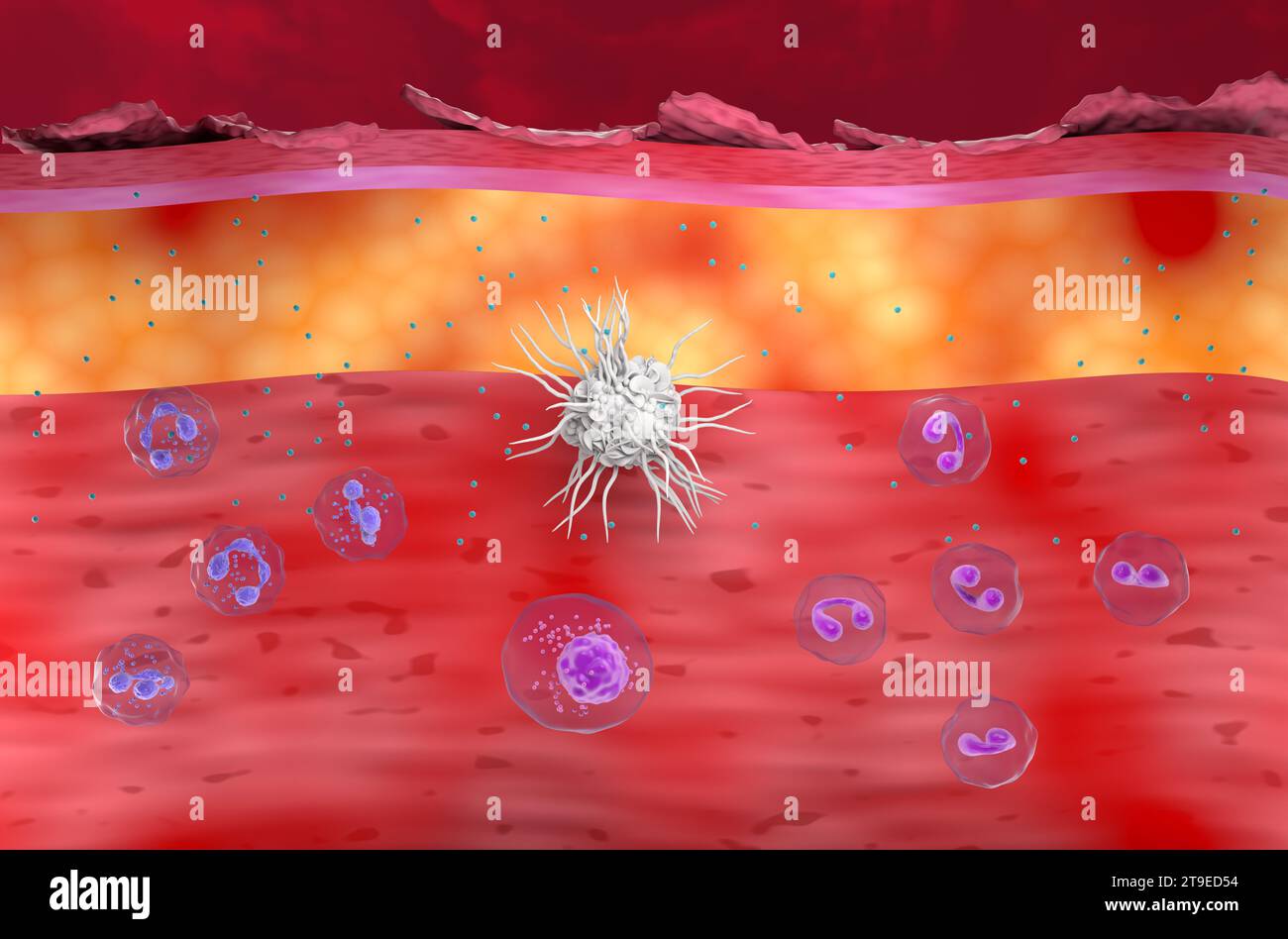 Entzündliche Haut bei Ekzem, atopischer Dermatitis (AD) - Vorderansicht 3D-Illustration Stockfoto