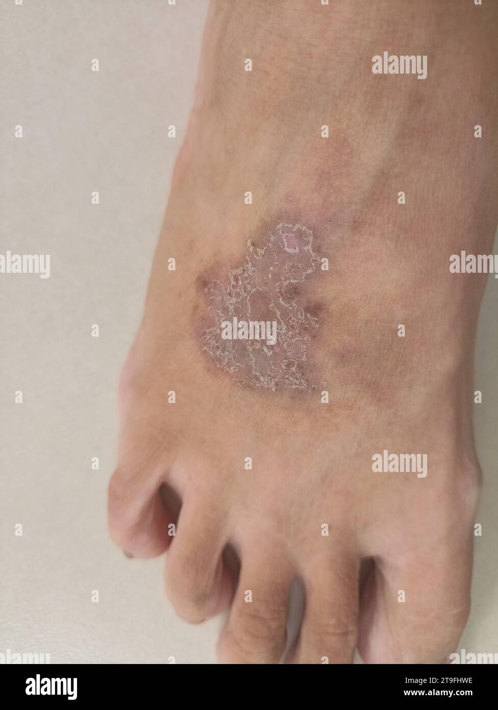 Ausschlag-Ekzemedermatitis am Fuß. Entzündung der Haut Stockfoto