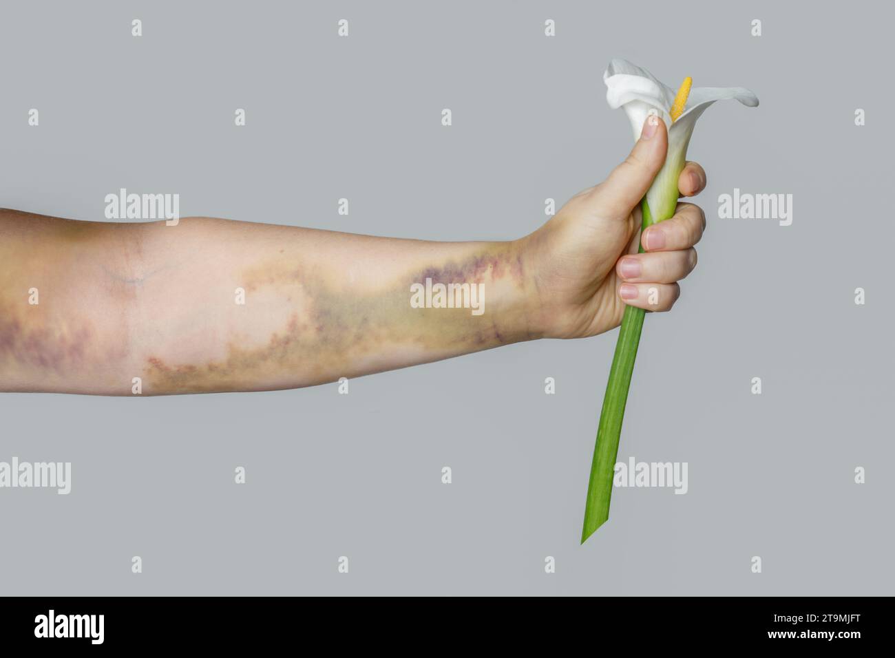 Frau Hand mit Bluterguss, die weiße Blume nah auf grauem Hintergrund hält. Autounfallnarbe oder Lungenembolie-Behandlung Stockfoto
