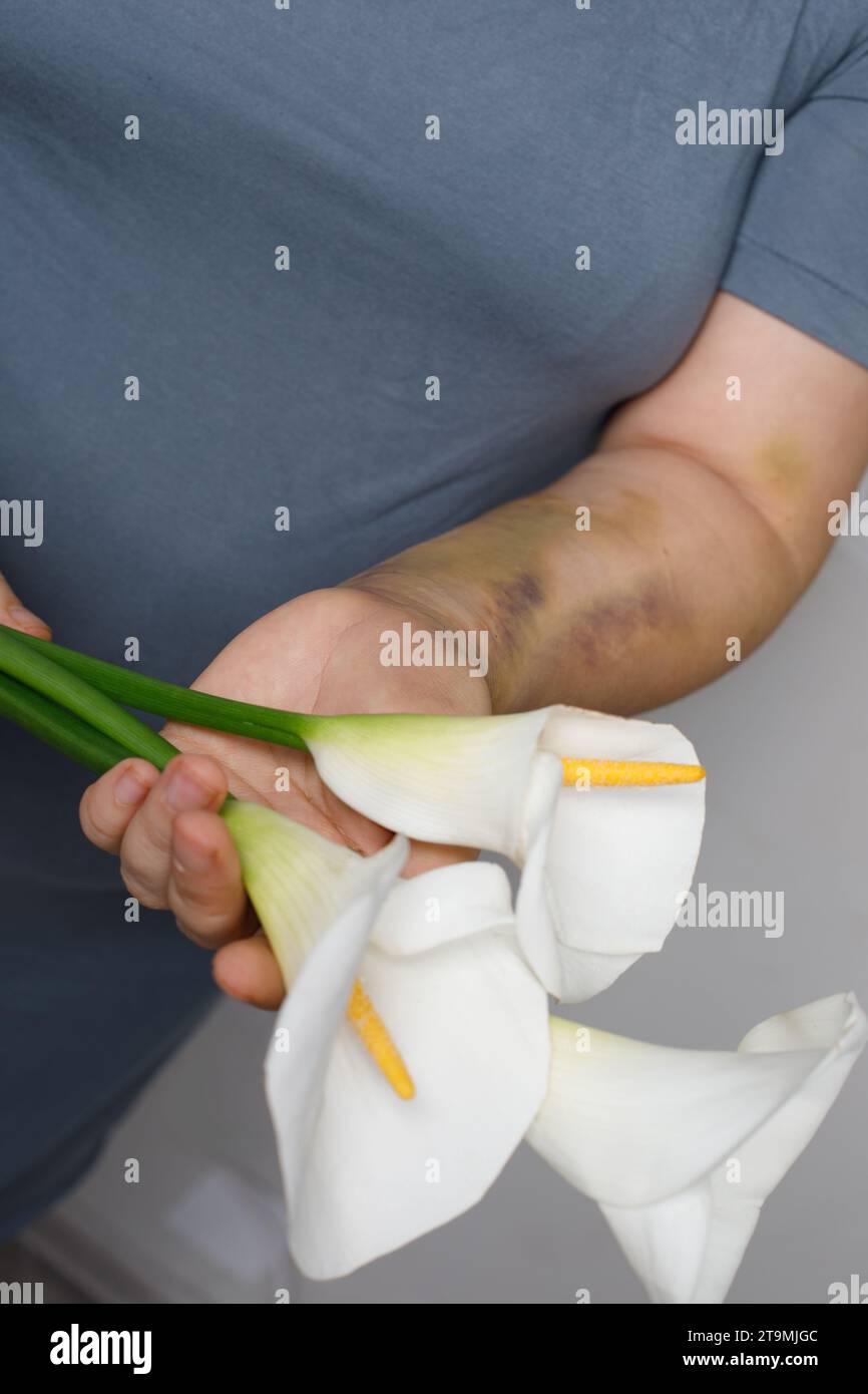 Autounfallnarbe, Lungenemboliebehandlung oder häusliches Gewaltkonzept. Weibliche Hand mit blauen Flecken und weißen Lilienblüten aus nächster Nähe. Stockfoto