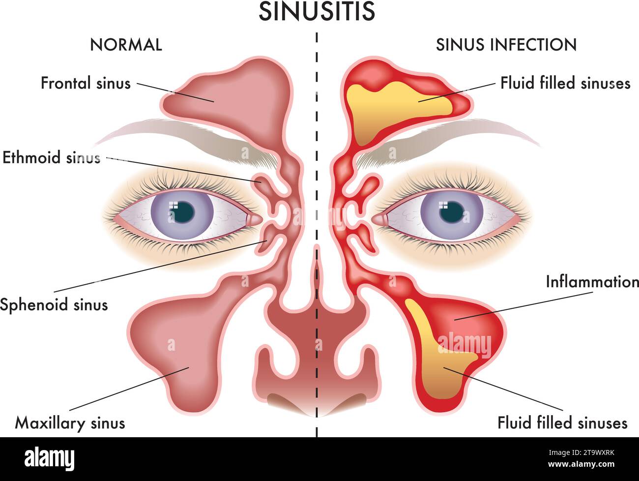 Medizinische Darstellung der Symptome der Sinusitis. Stock Vektor