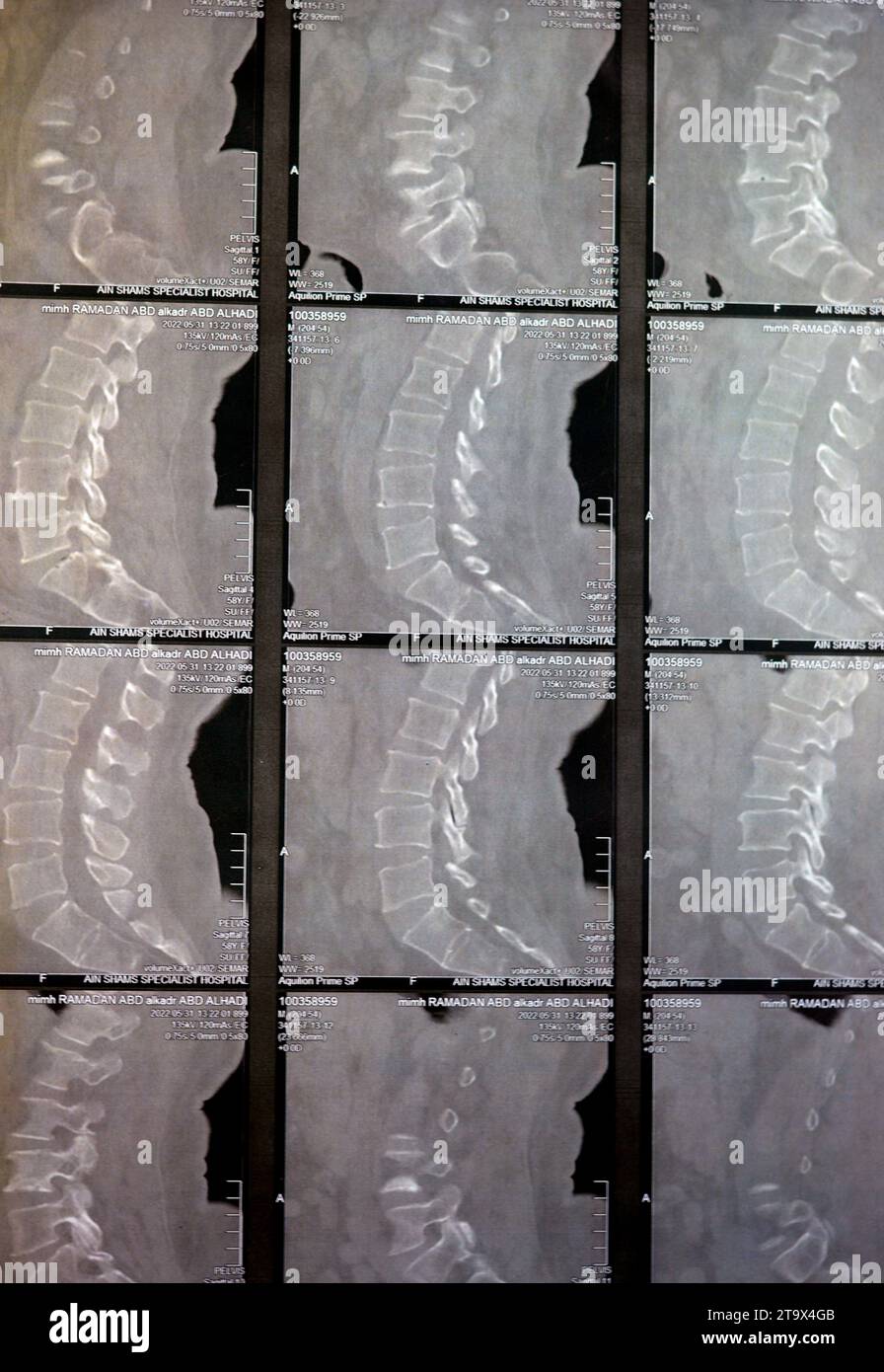 Kairo, Ägypten, 15. Oktober 2023: CT-Scan der lumbosakralen Wirbelsäule zeigt Spondyloseveränderungen, L4-L5, L5-S1 diffuse Bandscheibenwölbungen, bilaterale Facettenjoi Stockfoto