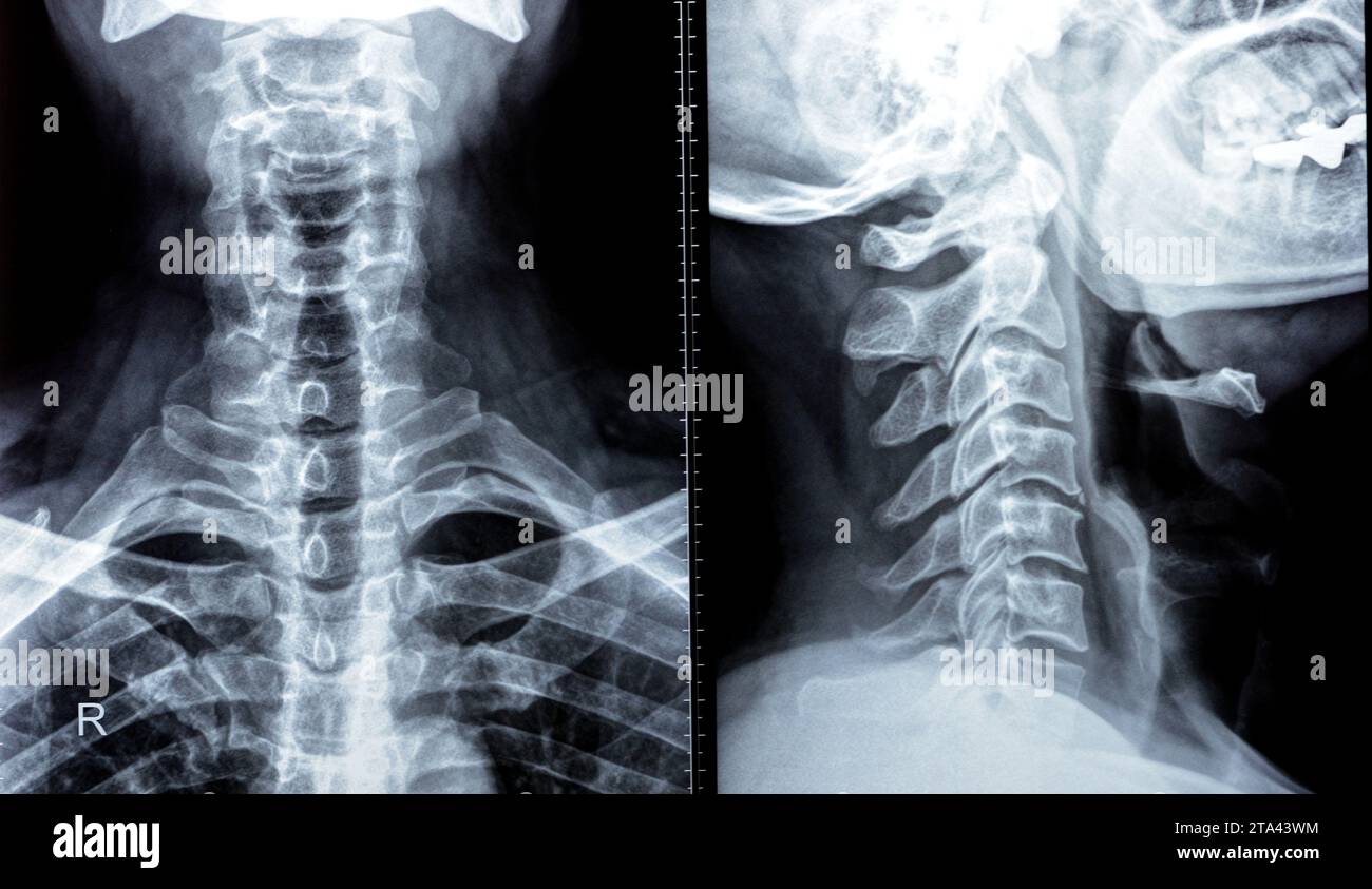 Die Röntgenaufnahme der Halswirbelsäule zeigte eine begradigte Halswirbelkurve, Spondylose osteophytische Lippen der Endplatten C3, C4, C5, schmale Bandscheibe sp Stockfoto