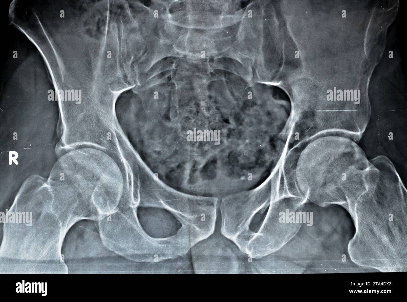 Eine einfache Röntgenaufnahme beider Hüftgelenke ergab eine leichte Verengung des superolateralen Aspekts beider Hüftgelenkspalten mit subchondraler Sklerose des gegenüberliegenden A Stockfoto