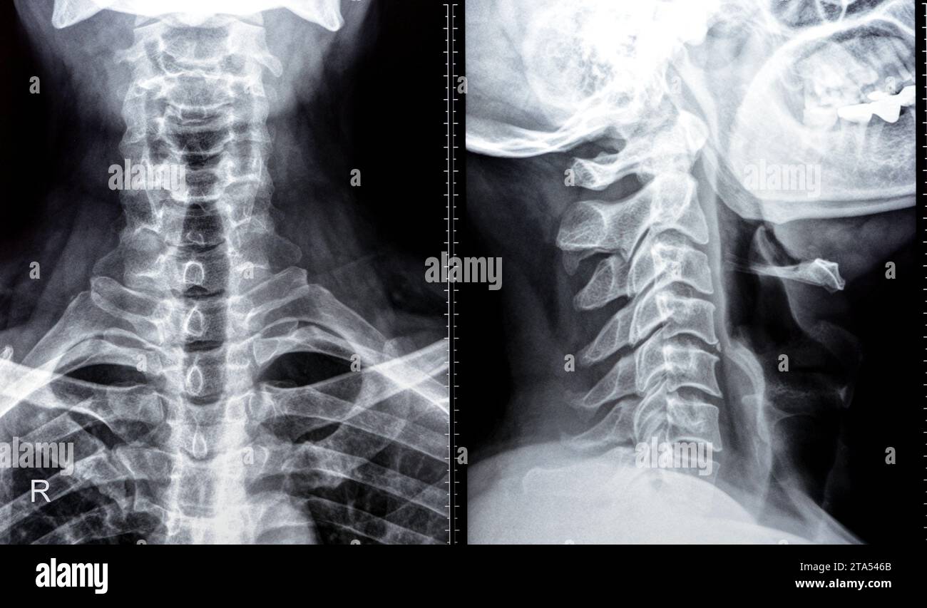 Die Röntgenaufnahme der Halswirbelsäule zeigte eine begradigte Halswirbelkurve, Spondylose osteophytische Lippen der Endplatten C3, C4, C5, schmale Bandscheibe sp Stockfoto