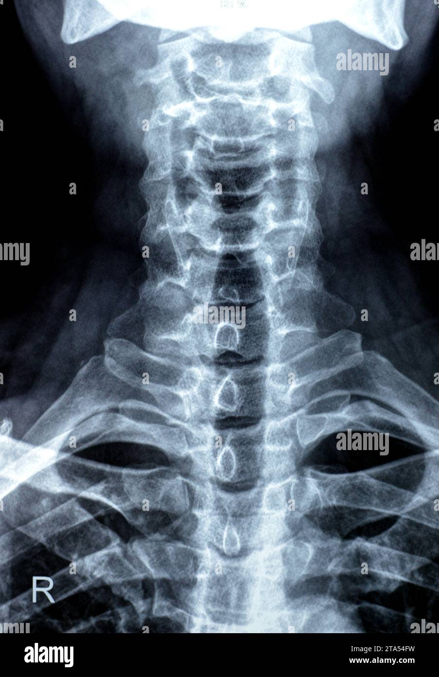 Die Röntgenaufnahme der Halswirbelsäule zeigte eine begradigte Halswirbelkurve, Spondylose osteophytische Lippen der Endplatten C3, C4, C5, schmale Bandscheibe sp Stockfoto