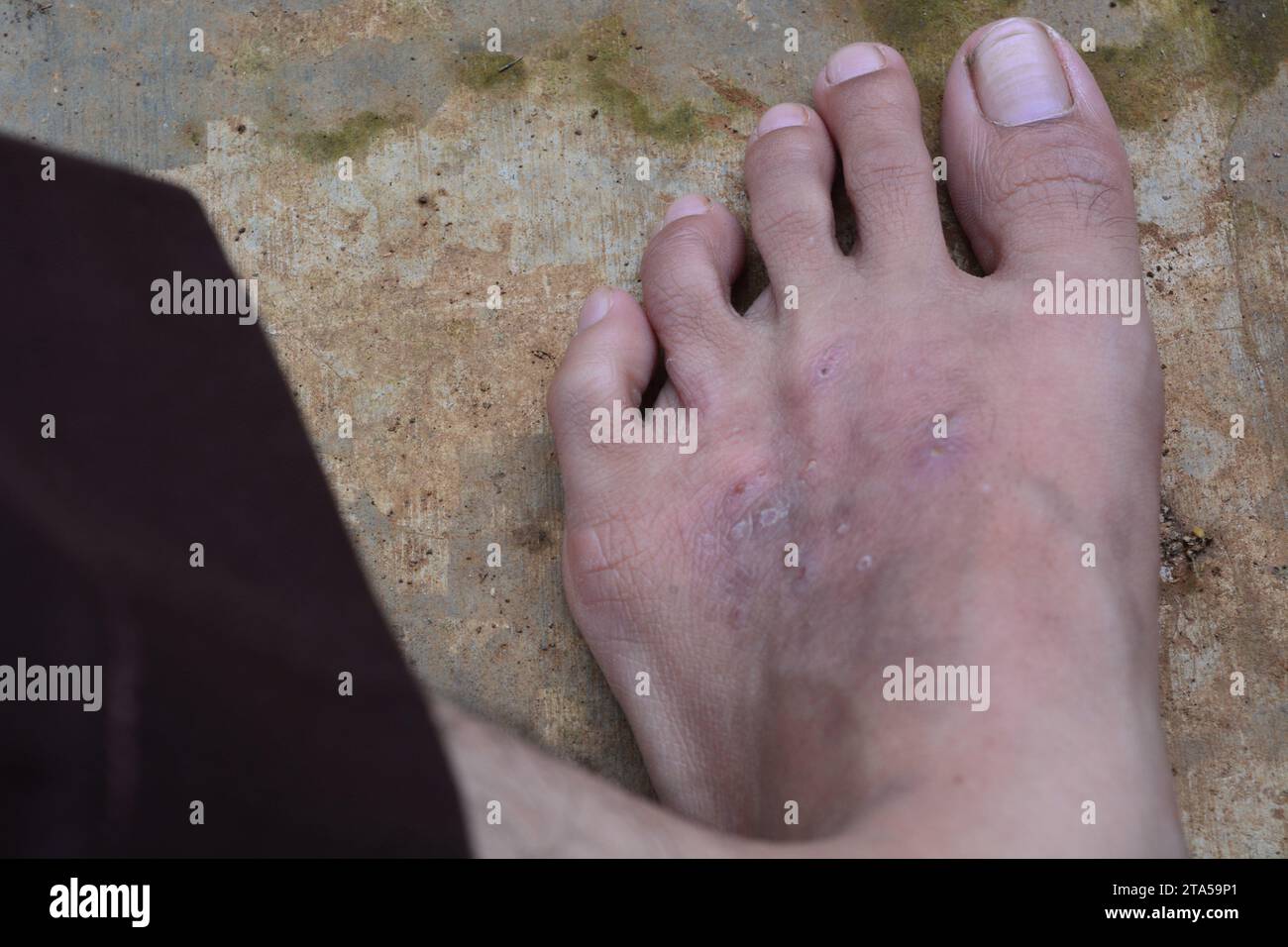 Fotos von juckenden Füßen, Fotos mit dem Thema Gesundheit Stockfoto