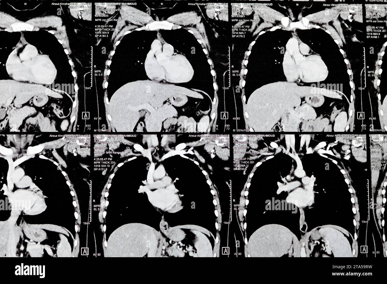 Kairo, Ägypten, 15. Oktober 2023: CT-Scan axialer Schnitte durch den Brustkorb mit Kontrastmittelinjektion mit niedrigem Grad an Entzündungsreaktion, parenchymalen Venen Stockfoto