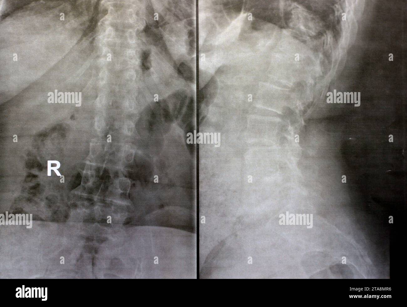 Das einfache Röntgenbild der dorsalen und der Holzwirbelsäule zeigt spondylotische Veränderungen, die Begradigung der dorsalen und der Holzwirbelsäule, die Bandscheibenräume sind intakt, Stockfoto