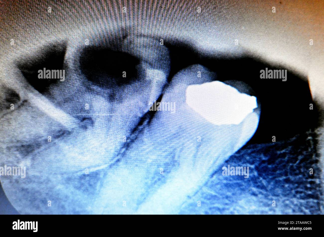 Röntgenbild des 8. Rechten unteren Zahnes mit Karies, nach freiliegenden Nerven und starken Schmerzen, Schwellungen und Entzündungen, Weisheitszähne sind die Backenzähne Stockfoto