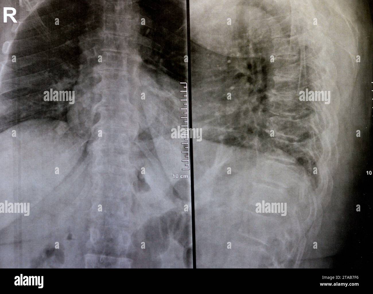 Das einfache Röntgenbild der dorsalen und der Holzwirbelsäule zeigt spondylotische Veränderungen, die Begradigung der dorsalen und der Holzwirbelsäule, die Bandscheibenräume sind intakt, Stockfoto