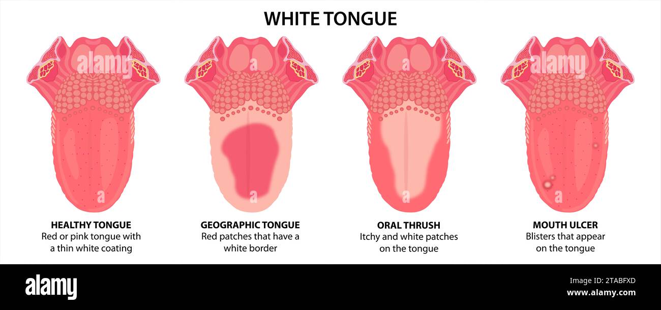 Illustration der weißen Zunge, Mundsoor, Mundgeschwür und geografische Zunge Stockfoto