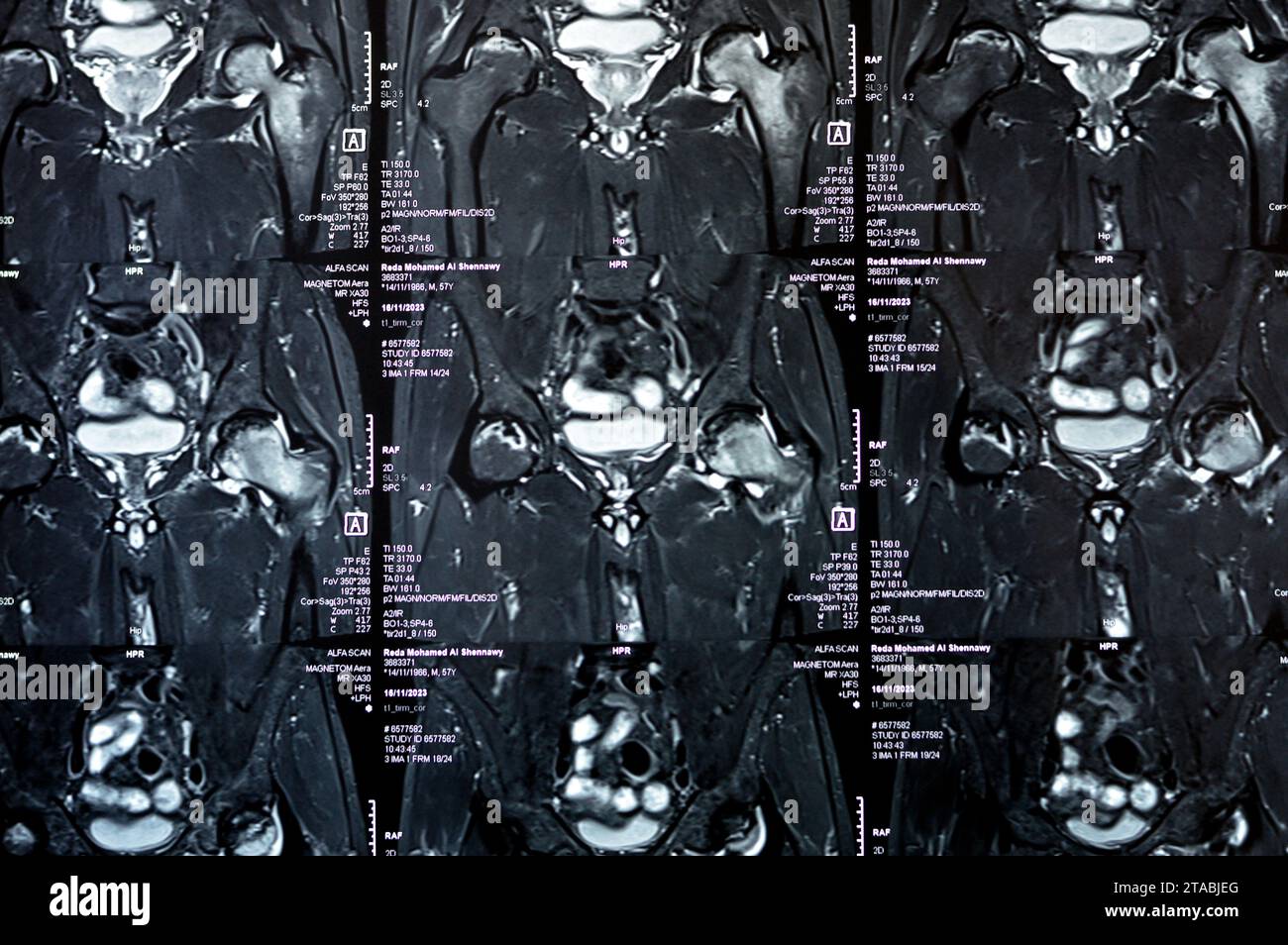 Kairo, Ägypten, 21. November 2023: MRT des Hüftgelenks mit beidseitiger Hüftkopfnekrose, ausgedehntem Knochenmarködem des linken Hüftkopfes, des Halses, Stockfoto