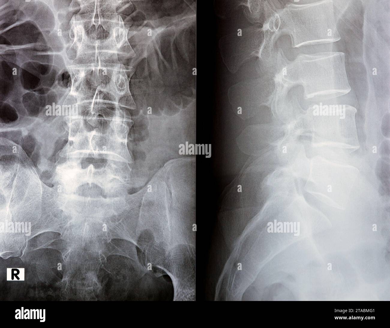 Die digitale Röntgenuntersuchung der Lumbosakralen Wirbelsäule zeigt