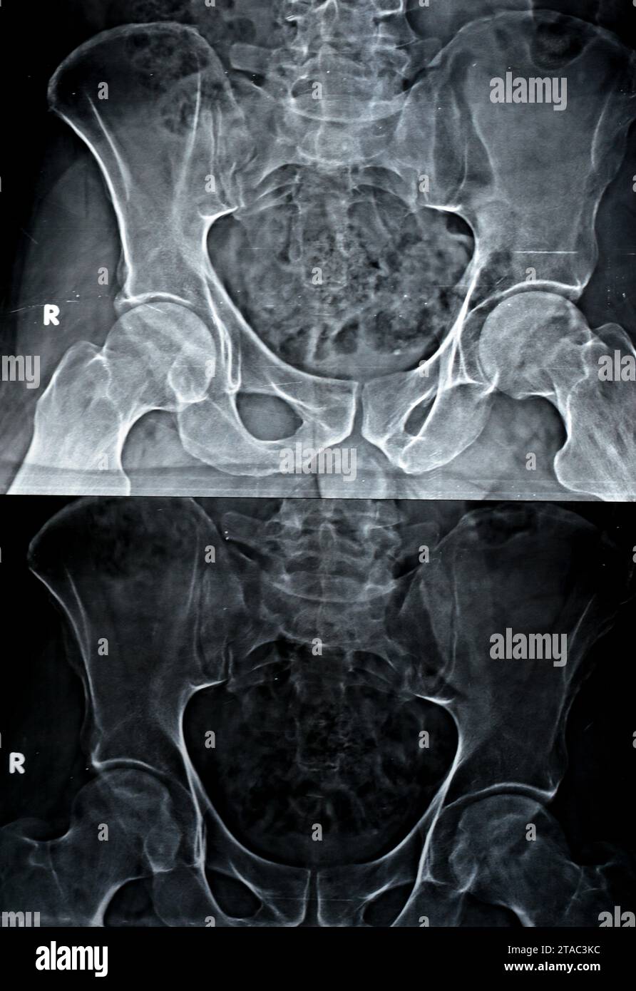 Eine einfache Röntgenaufnahme beider Hüftgelenke ergab eine leichte Verengung des superolateralen Aspekts beider Hüftgelenkspalten mit subchondraler Sklerose des gegenüberliegenden A Stockfoto