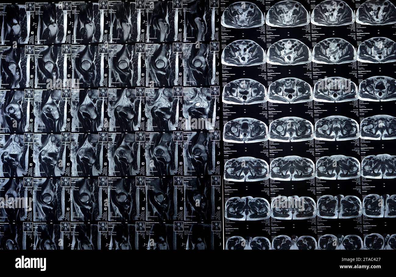 Kairo, Ägypten, 21. November 2023: MRT des Hüftgelenks mit beidseitiger Hüftkopfnekrose, ausgedehntem Knochenmarködem des linken Hüftkopfes, des Halses, Stockfoto