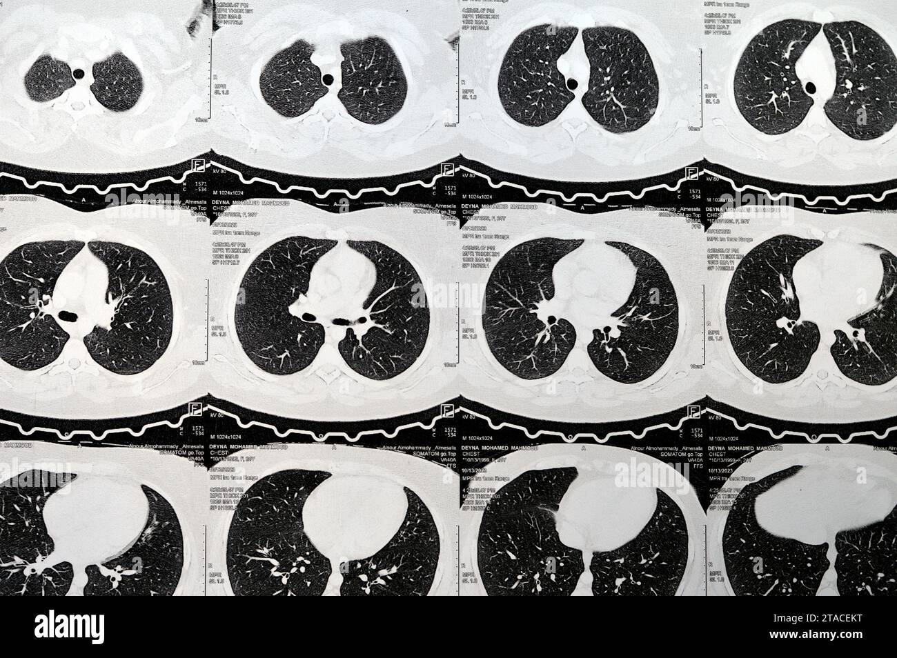 Kairo, Ägypten, 15. Oktober 2023: CT-Scan axialer Schnitte durch den Brustkorb mit Kontrastmittelinjektion mit niedrigem Grad an Entzündungsreaktion, parenchymalen Venen Stockfoto