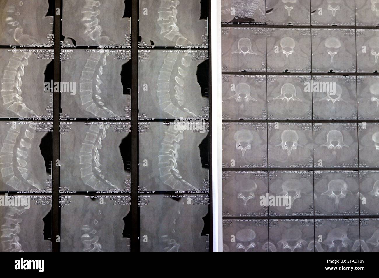 Kairo, Ägypten, 15. Oktober 2023: CT-Scan der lumbosakralen Wirbelsäule zeigt Spondyloseveränderungen, L4-L5, L5-S1 diffuse Bandscheibenwölbungen, bilaterale Facettenjoi Stockfoto