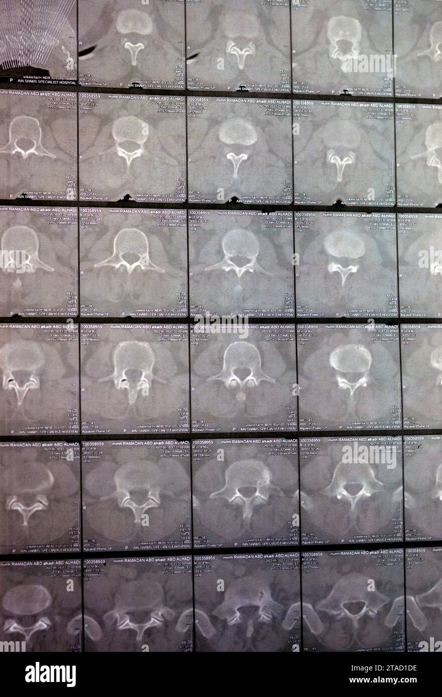Kairo, Ägypten, 15. Oktober 2023: CT-Scan der lumbosakralen Wirbelsäule zeigt Spondyloseveränderungen, L4-L5, L5-S1 diffuse Bandscheibenwölbungen, bilaterale Facettenjoi Stockfoto