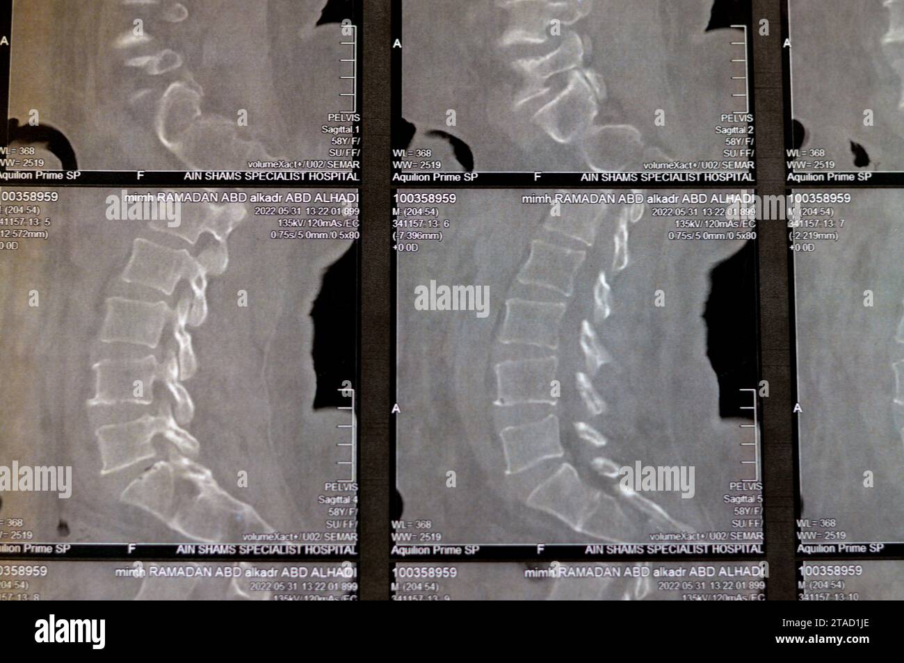 Kairo, Ägypten, 15. Oktober 2023: CT-Scan der lumbosakralen Wirbelsäule zeigt Spondyloseveränderungen, L4-L5, L5-S1 diffuse Bandscheibenwölbungen, bilaterale Facettenjoi Stockfoto