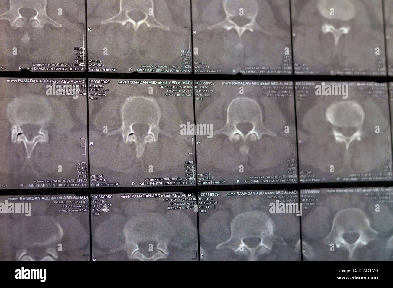 Kairo, Ägypten, 15. Oktober 2023: CT-Scan der lumbosakralen Wirbelsäule zeigt Spondyloseveränderungen, L4-L5, L5-S1 diffuse Bandscheibenwölbungen, bilaterale Facettenjoi Stockfoto