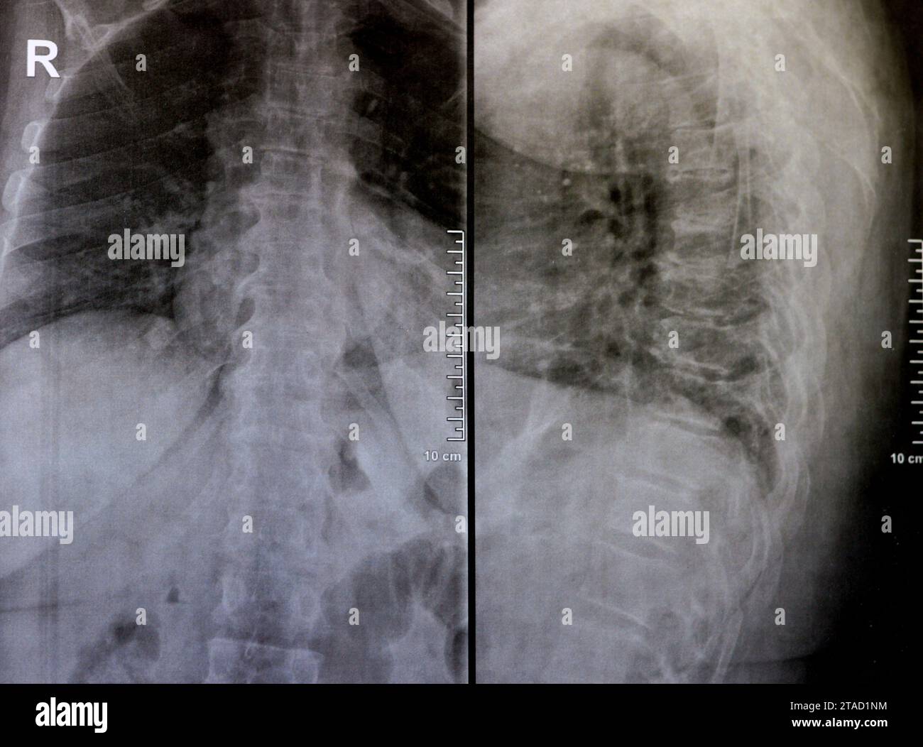 Das einfache Röntgenbild der dorsalen und der Holzwirbelsäule zeigt spondylotische Veränderungen, die Begradigung der dorsalen und der Holzwirbelsäule, die Bandscheibenräume sind intakt, Stockfoto