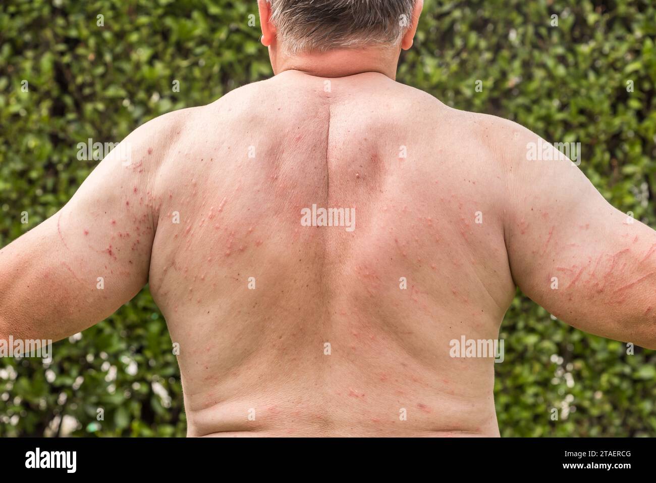 Rücken und Arme des Mannes mit Hautausschlag auf, Symptome des Juckens, Hautallergie. Stockfoto