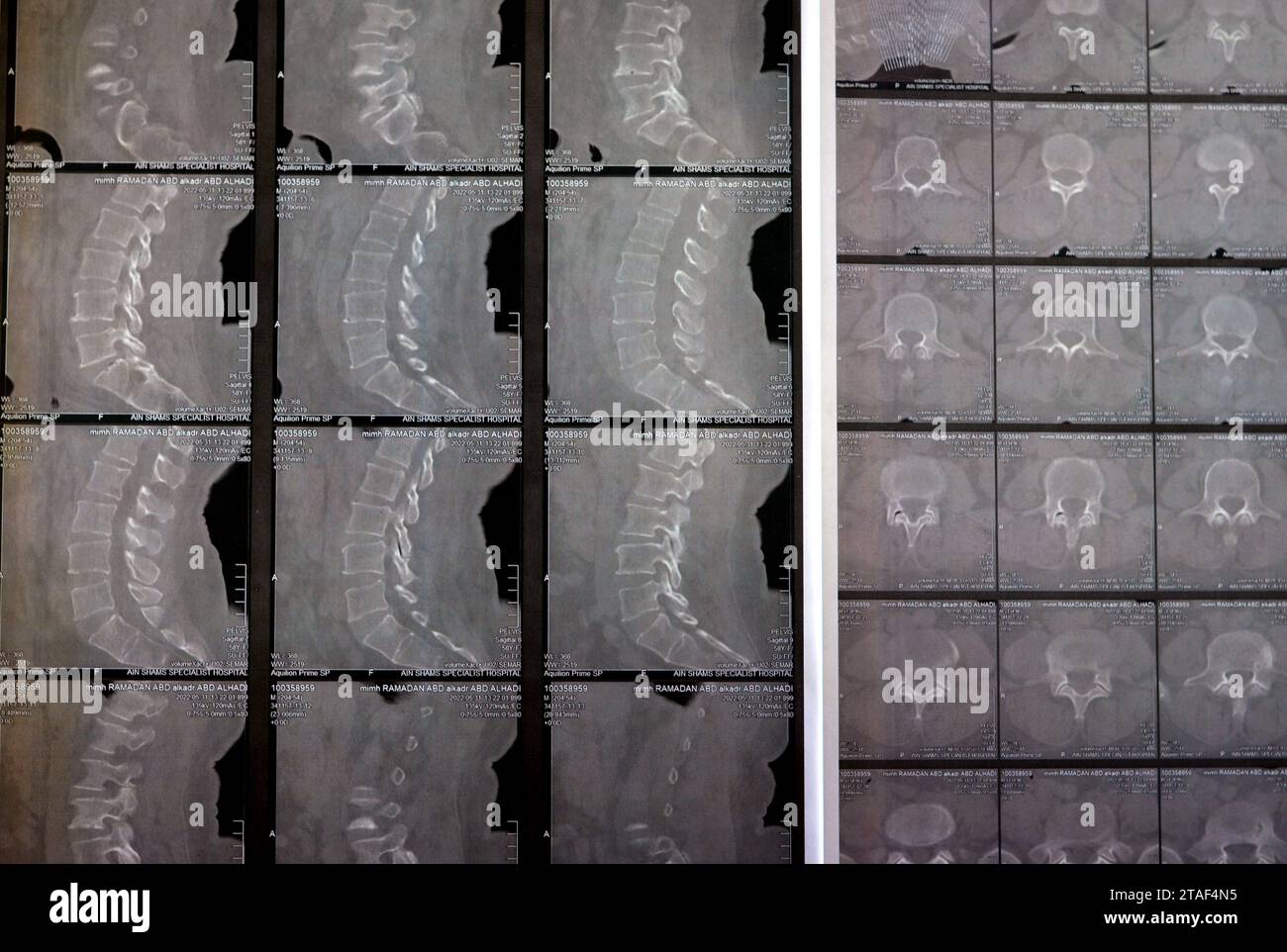 Kairo, Ägypten, 15. Oktober 2023: CT-Scan der lumbosakralen Wirbelsäule zeigt Spondyloseveränderungen, L4-L5, L5-S1 diffuse Bandscheibenwölbungen, bilaterale Facettenjoi Stockfoto