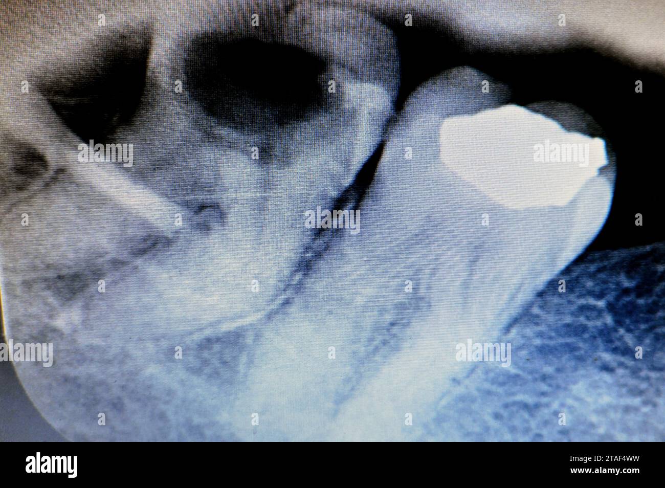Röntgenbild des 8. Rechten unteren Zahnes mit Karies, nach freiliegenden Nerven und starken Schmerzen, Schwellungen und Entzündungen, Weisheitszähne sind die Backenzähne Stockfoto