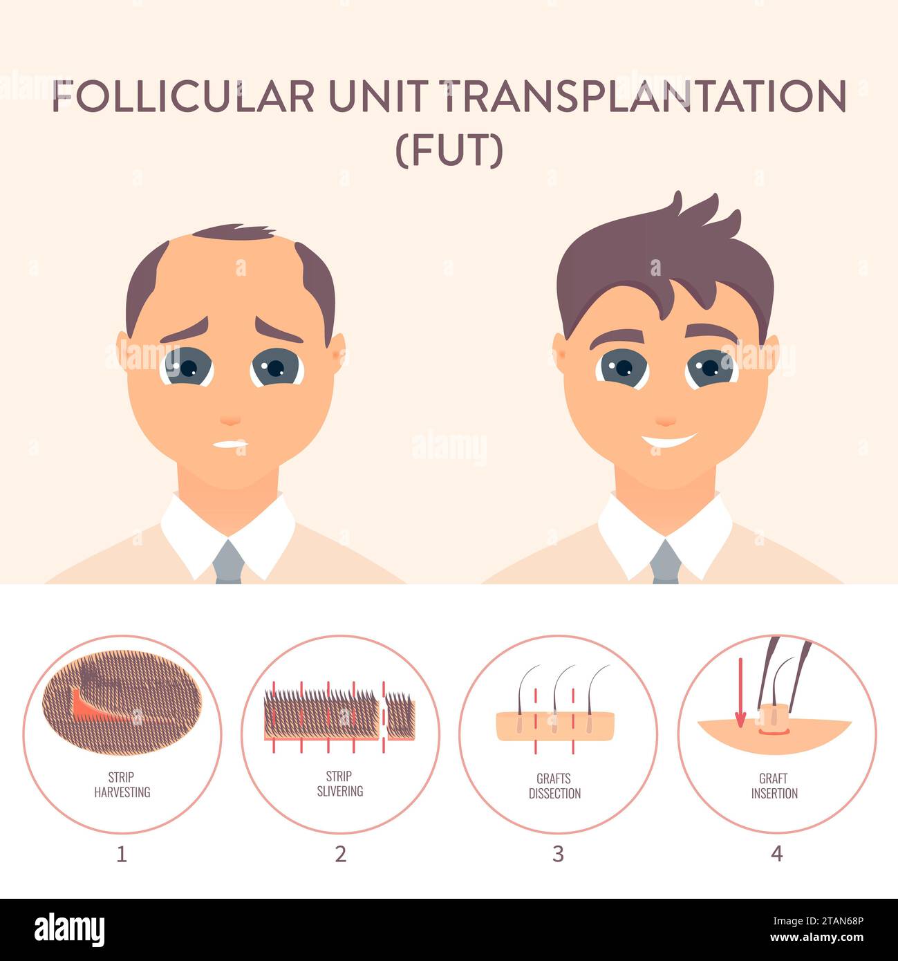 FUT-Haartransplantation, konzeptuelle Illustration Stockfoto