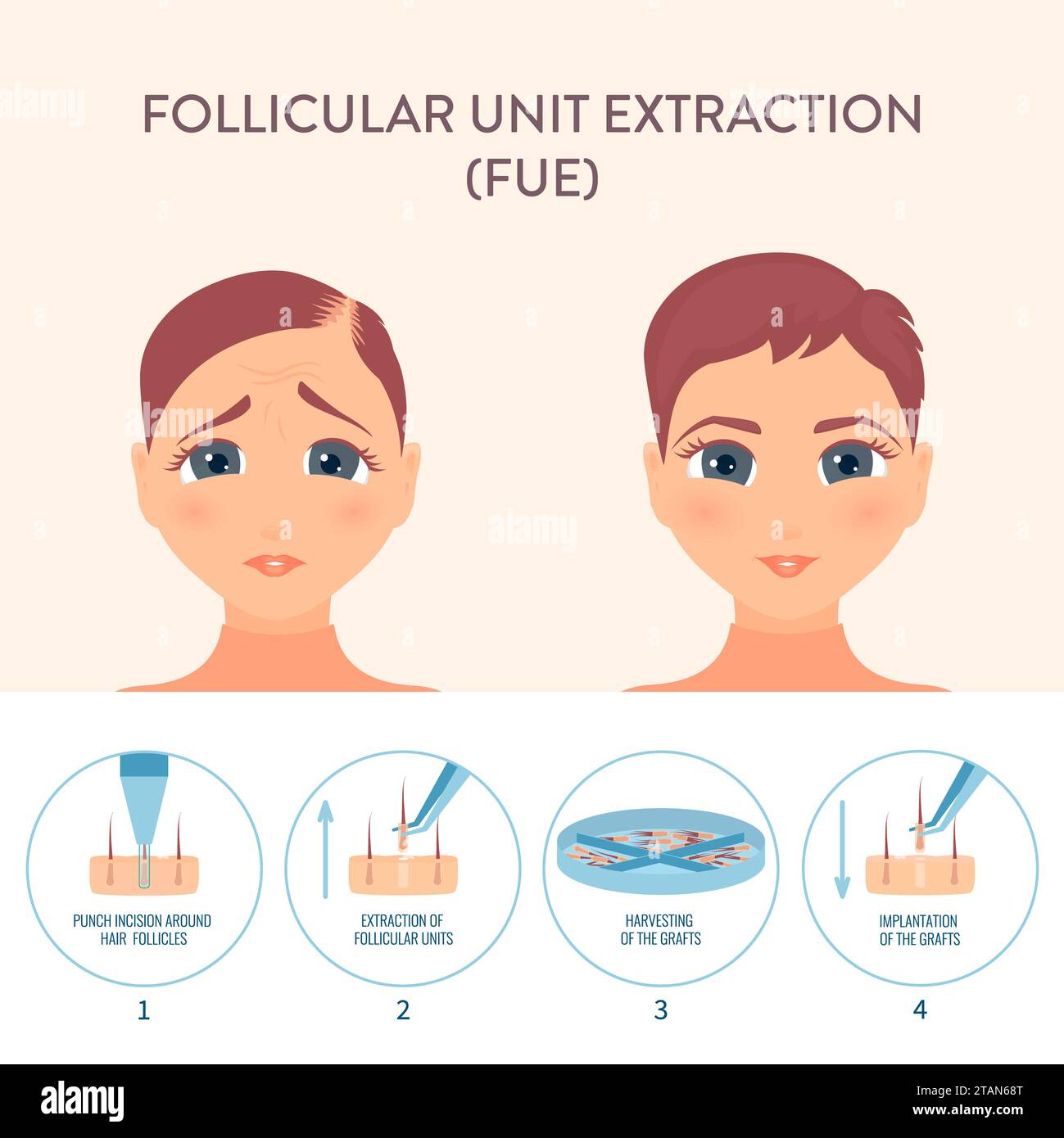 FuE-Haartransplantation, konzeptuelle Illustration Stockfoto