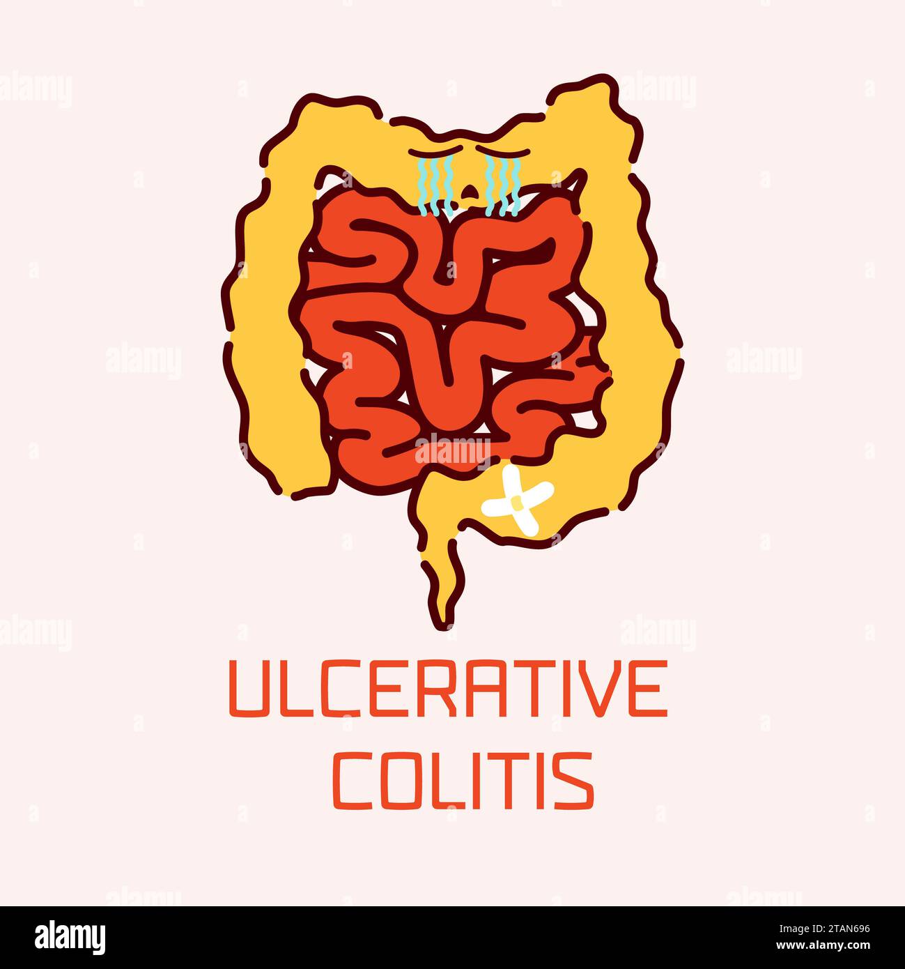 Colitis ulcerosa, konzeptuelle Illustration Stockfoto