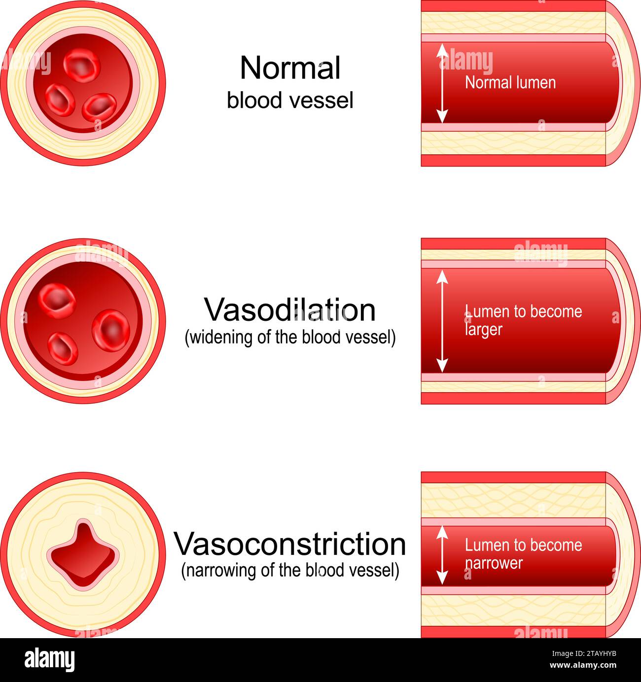 Vasokonstriktion und Vasodilatation einer Arterie. Venen-Lumen. Querschnitt des Blutgefäßes mit roten Blutkörperchen. Vergleich von Normal, Constrict Stock Vektor