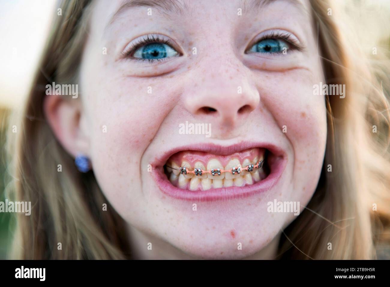 Teenager zeigt ihre Zahnspange; Lincoln, Nebraska, Vereinigte Staaten von Amerika Stockfoto