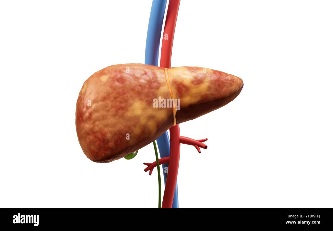 Leberorgan mit Fettleberzustand, 3D-Rendering. 3D-Abbildung. Stockfoto
