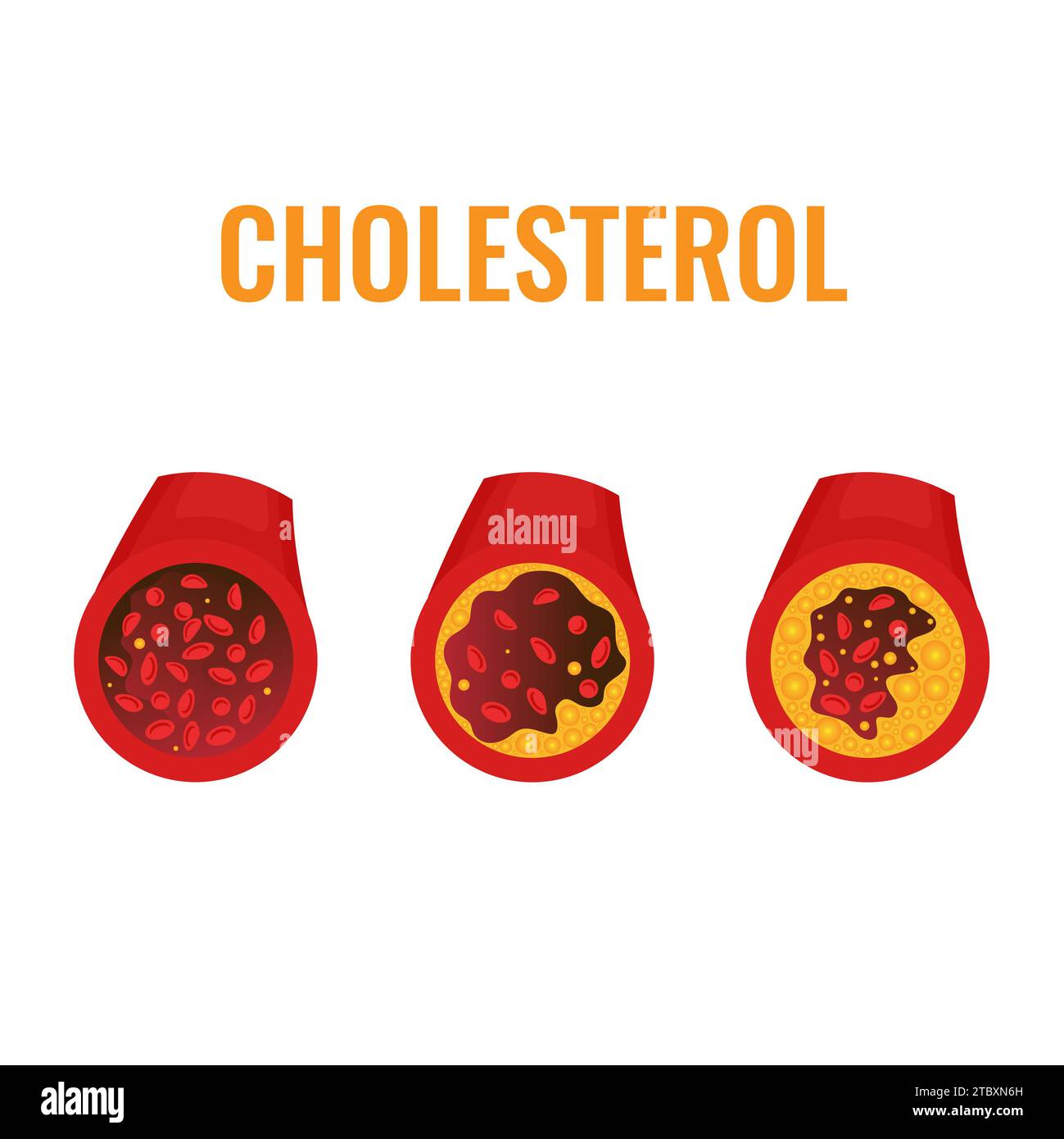 Atherosklerose, konzeptuelle Illustration Stockfoto