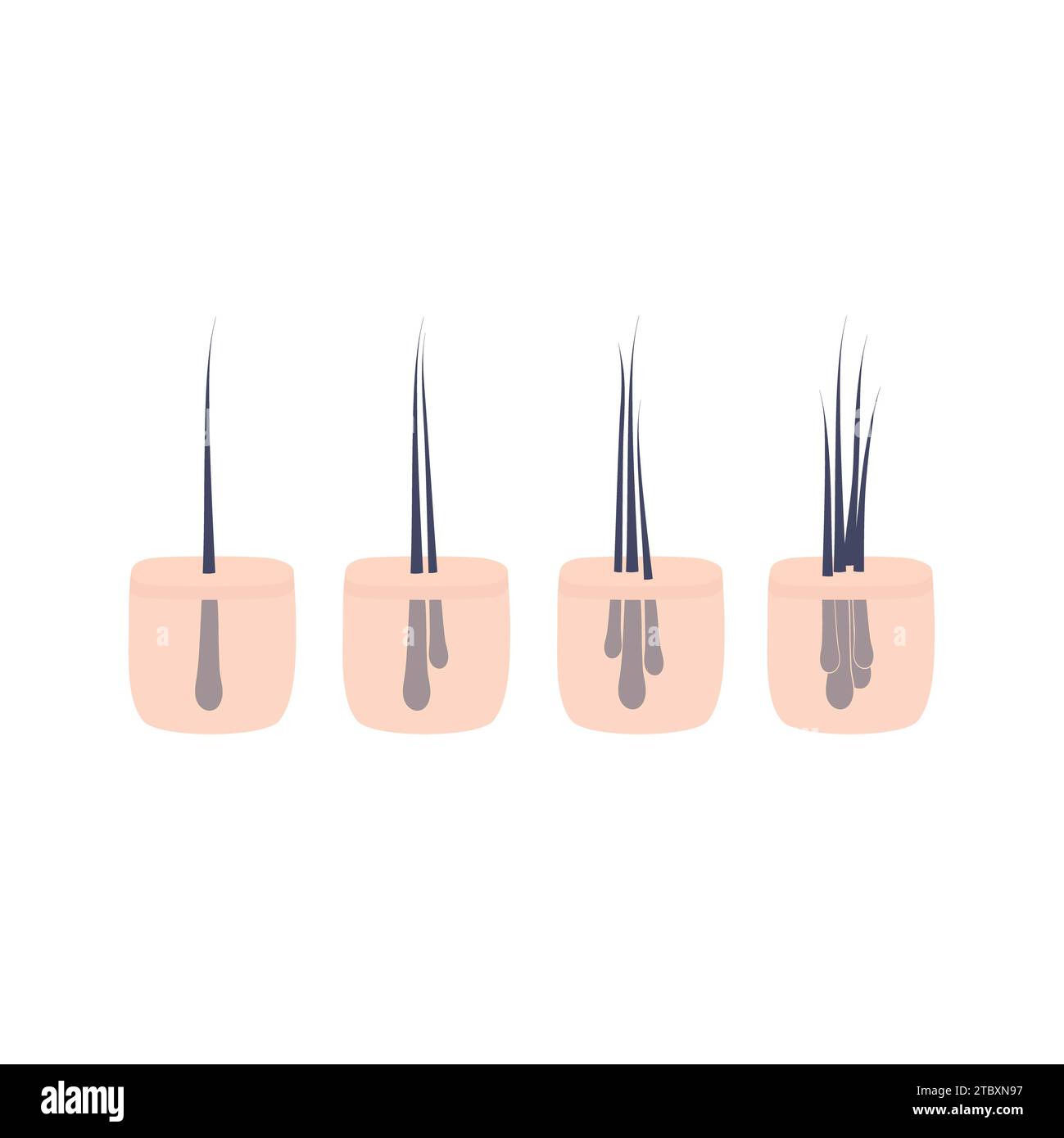 Haarmikrotransplantate, konzeptuelle Illustration Stockfoto