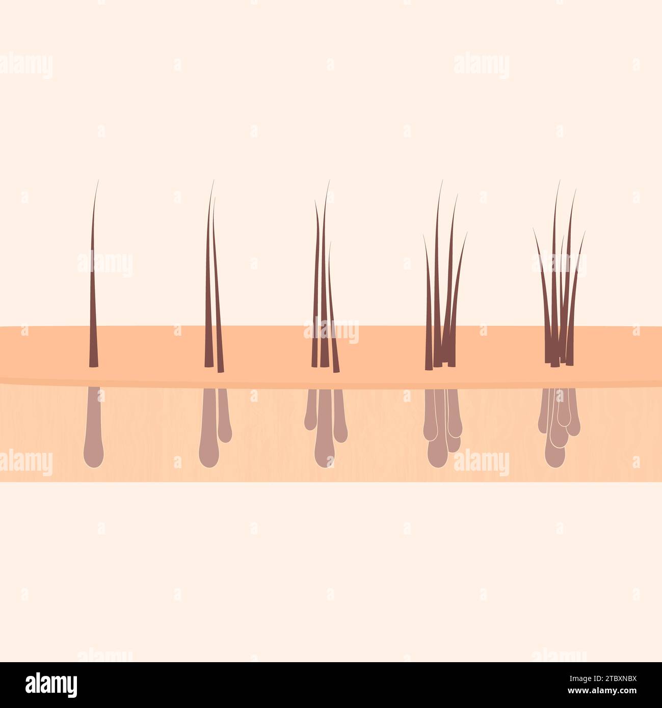 Haartransplantationstypen, konzeptuelle Illustration Stockfoto